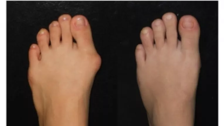 Masurile de prevenire a monturilor pot fi inutile daca exista un istoric familial