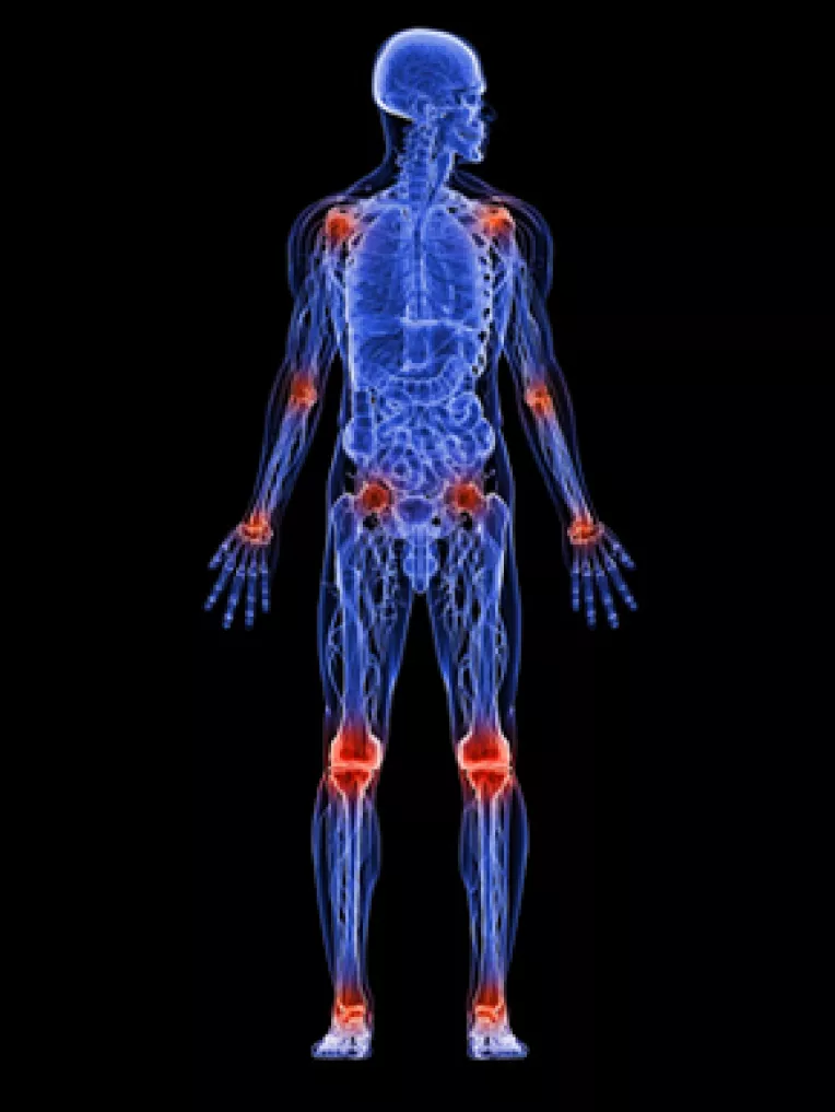 Reumatism: Cauzele, simptomele si tratamentul poliartritei reumatoide