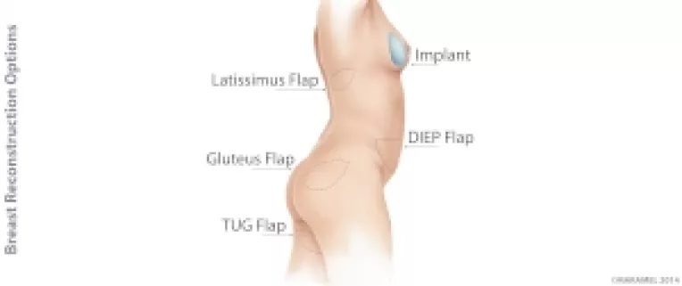 Tehnica reconstructiei sanilor